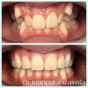 caso-exito-ortodoncia
