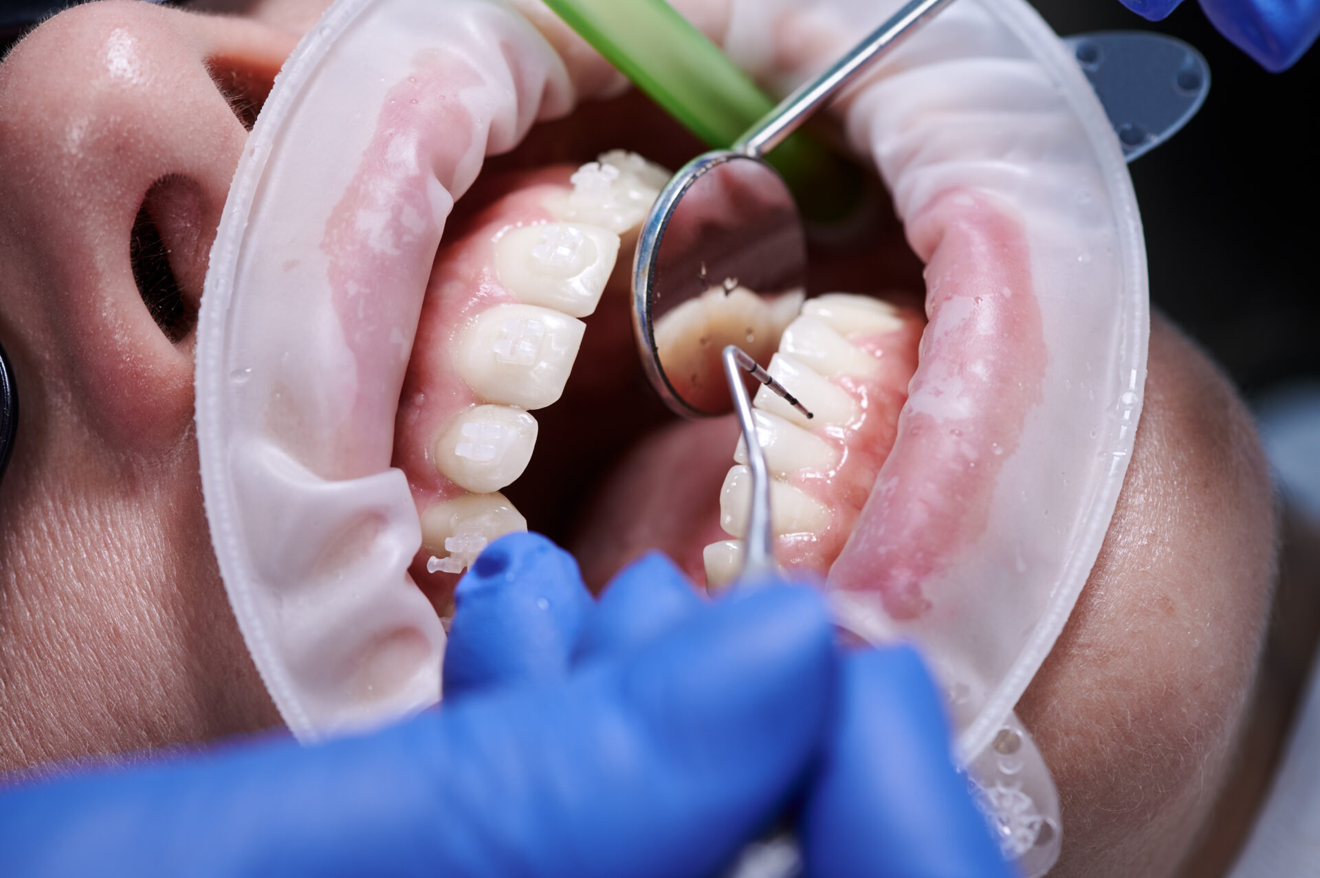 Close up of orthodontist checking woman teeth with dental mirror and explorer. Female patient with cheek retractor in mouth being examined by doctor at dental clinic. Concept of dentistry, orthodontic