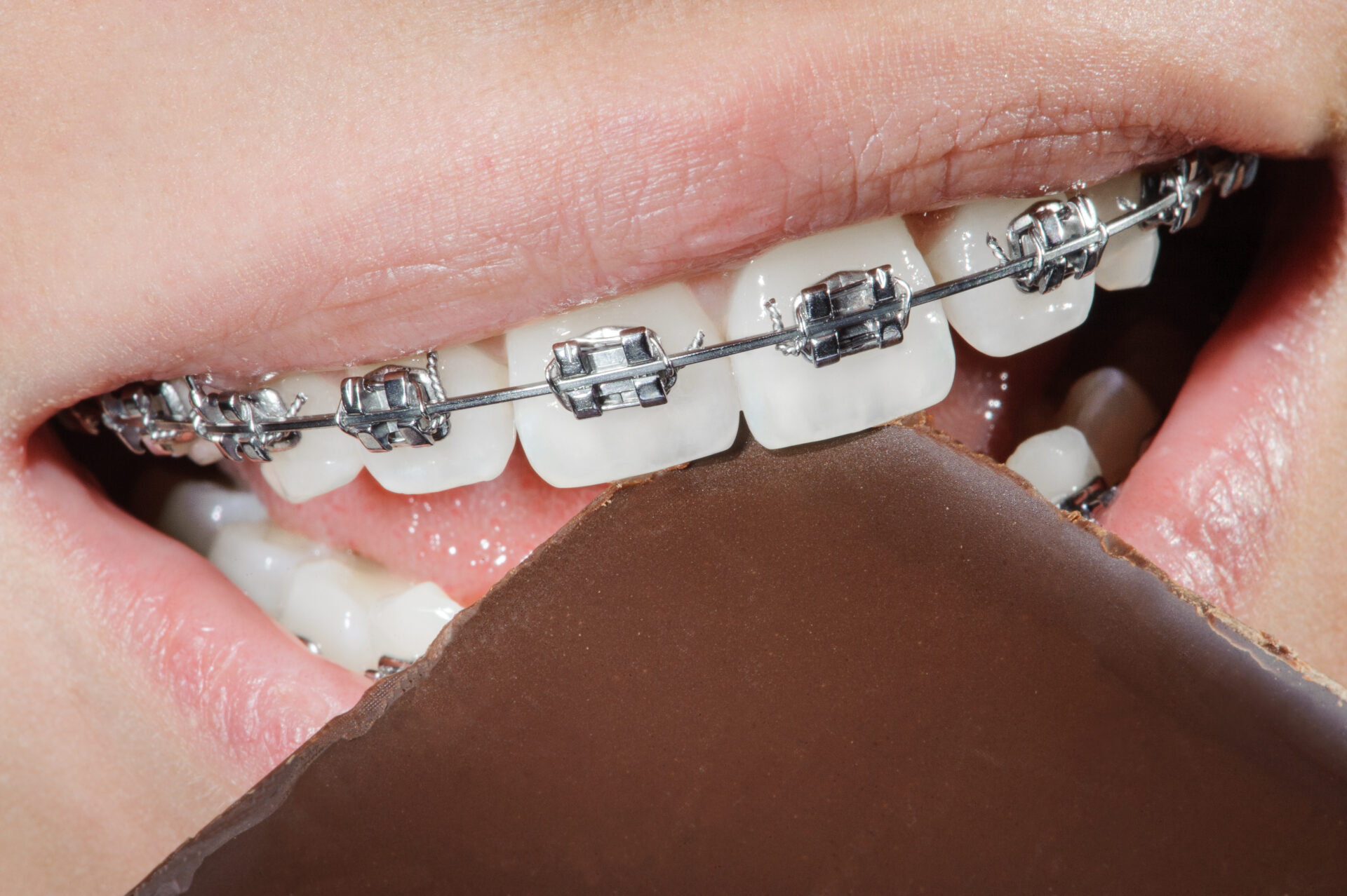 Teeth with dental braces biting chocolate. Orthodontic Treatment. Dental care Concept. Super macro. Healthy white teeth