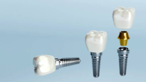 Implantes dentales vs puentes