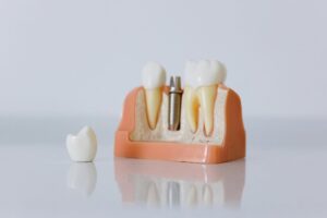 Implantes dentales en Lima